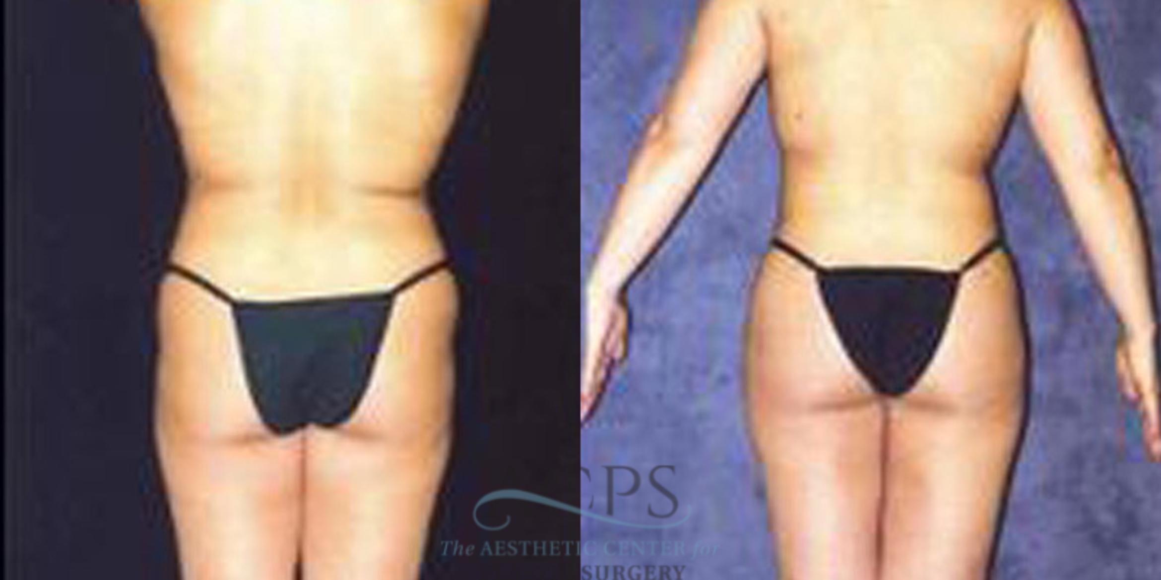 Before & After Breast Augmentation Case 254 Rear View: View in Houston, TX