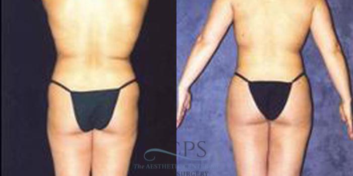 Before & After Breast Augmentation Case 254 Rear View: View in Houston, TX