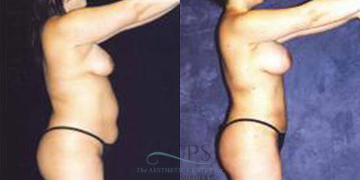 Before & After Breast Augmentation Case 254 Side View: View in Houston, TX