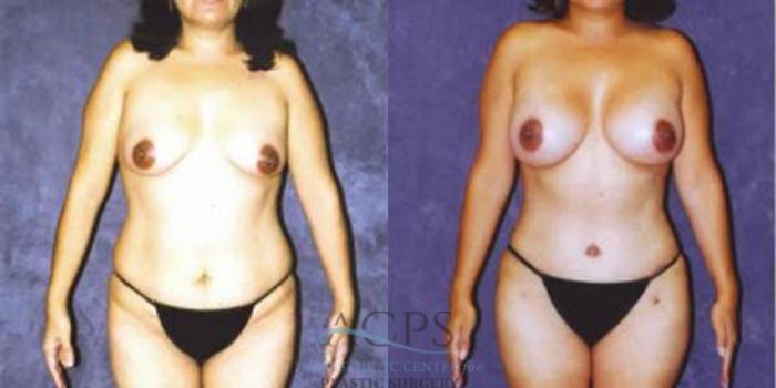 Before & After Liposuction Case 255 Front View: View in Houston, TX