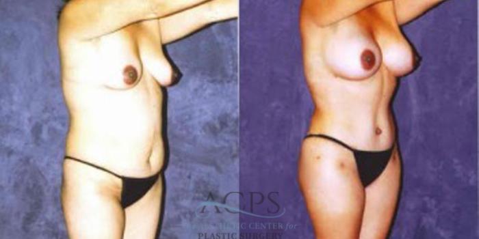 Before & After Liposuction Case 255 Oblique View: View in Houston, TX