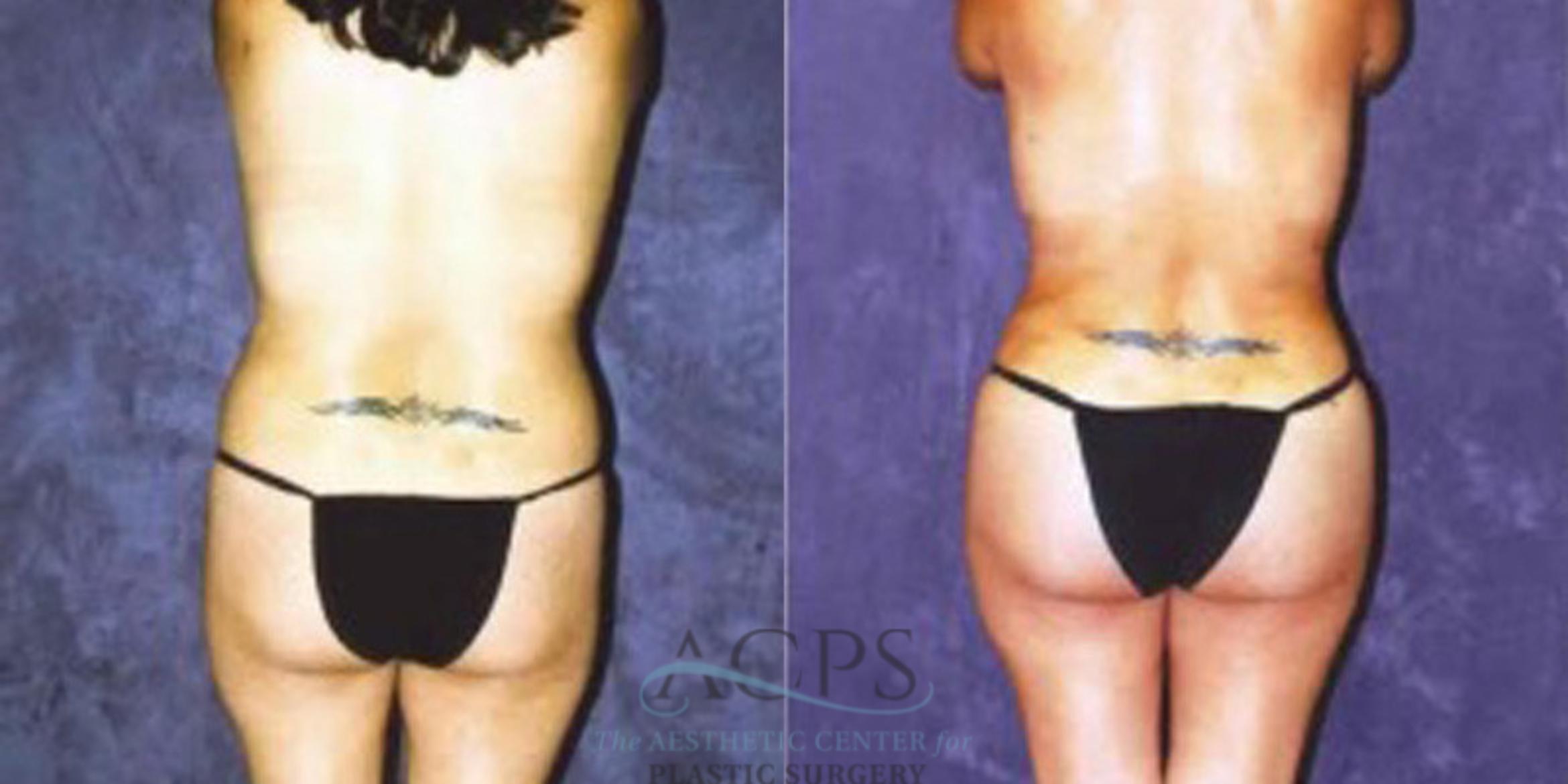 Before & After Liposuction Case 255 Rear View: View in Houston, TX