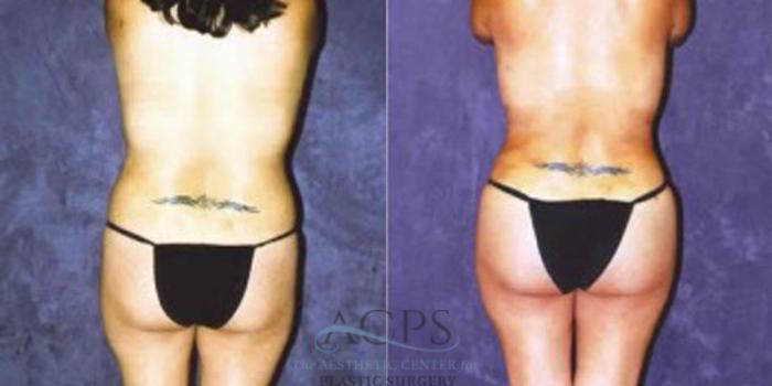 Before & After Liposuction Case 255 Rear View: View in Houston, TX
