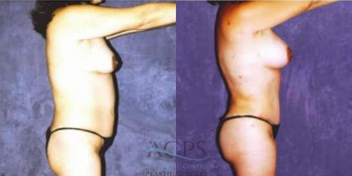 Before & After Liposuction Case 255 Side View: View in Houston, TX