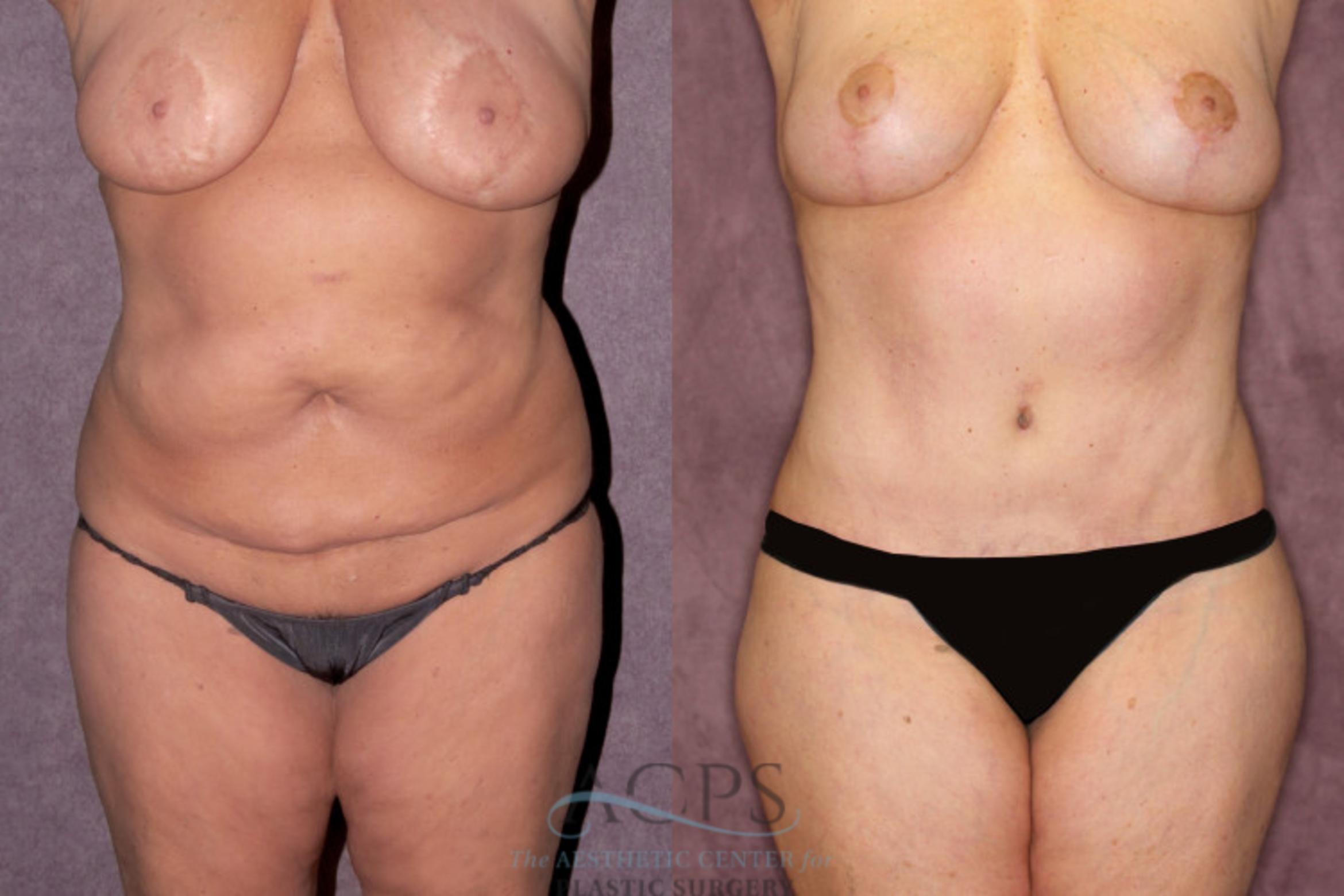 Before & After Liposuction Case 257 Front View: View in Houston, TX