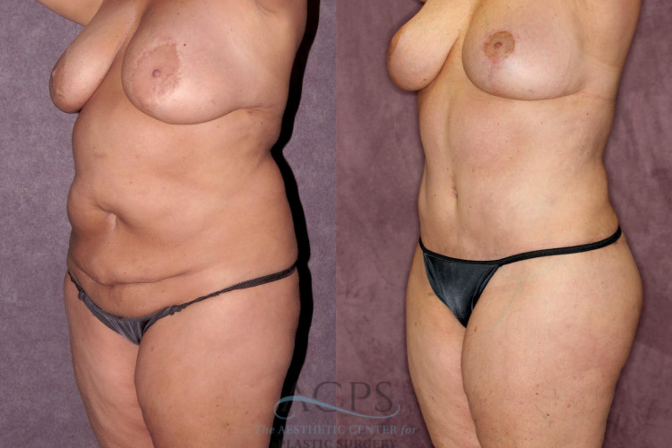 Before & After Liposuction Case 257 Oblique Left View: View in Houston, TX