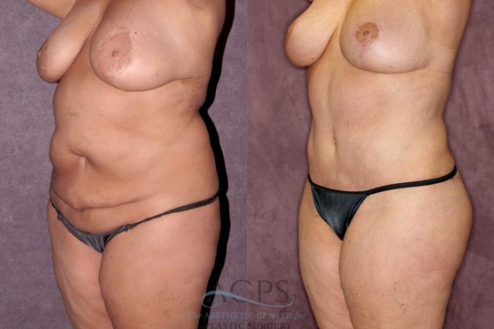Before & After Liposuction Case 257 Oblique Left View: View in Houston, TX