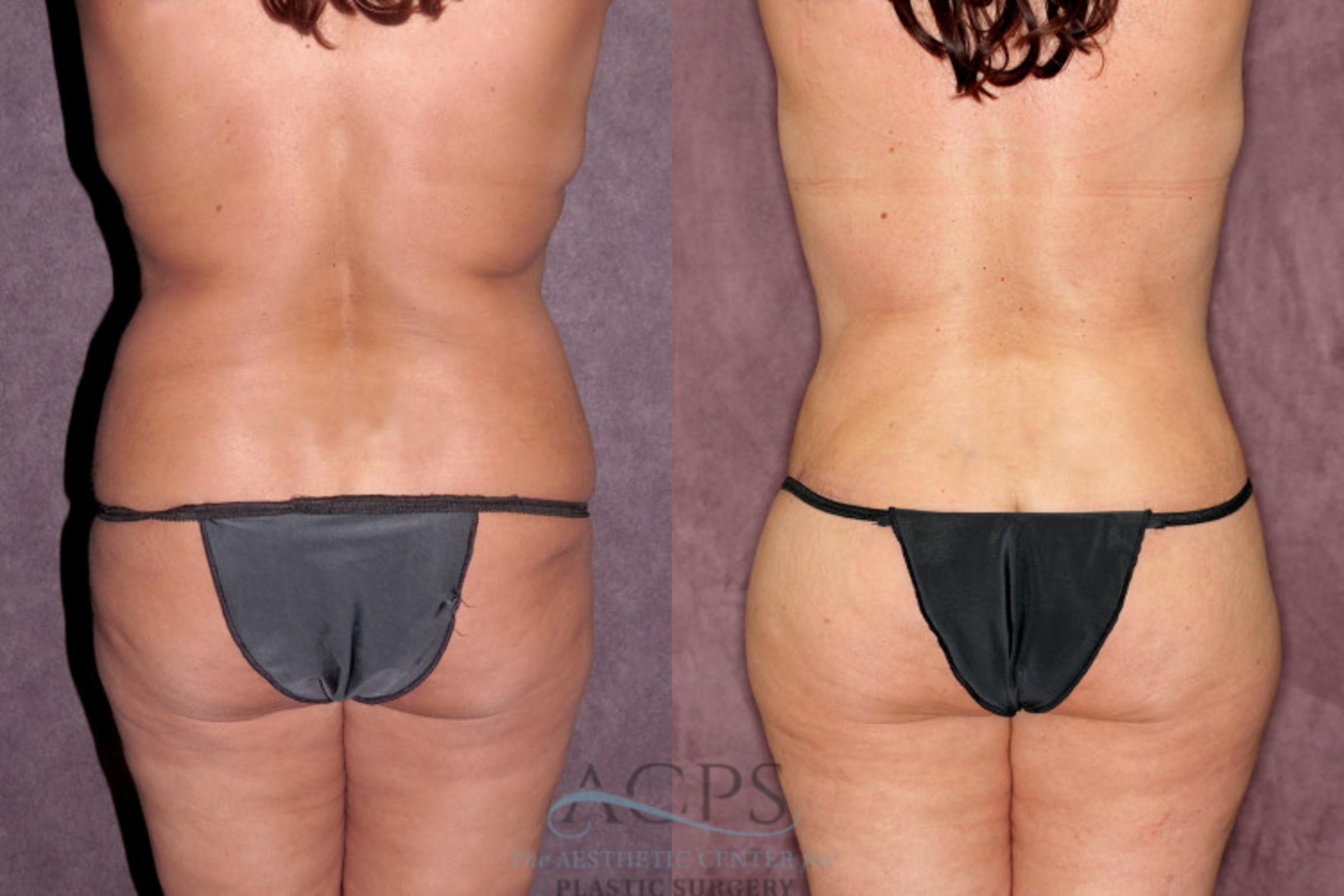 Before & After Liposuction Case 257 Rear View: View in Houston, TX