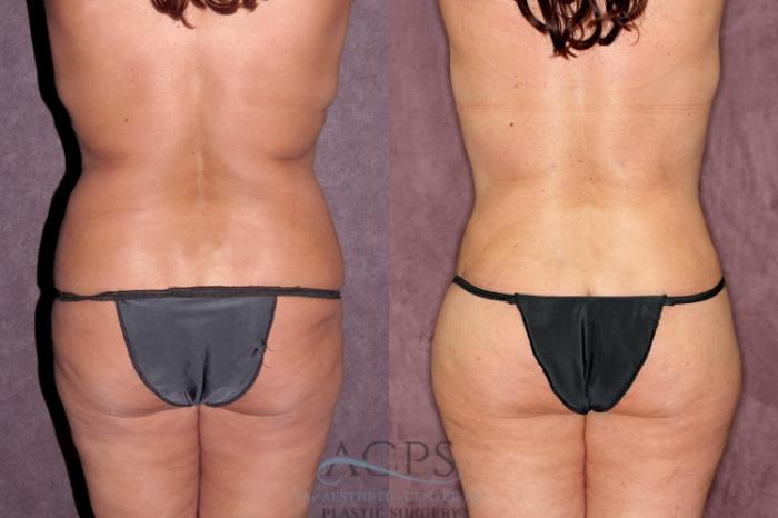Before & After Liposuction Case 257 Rear View: View in Houston, TX