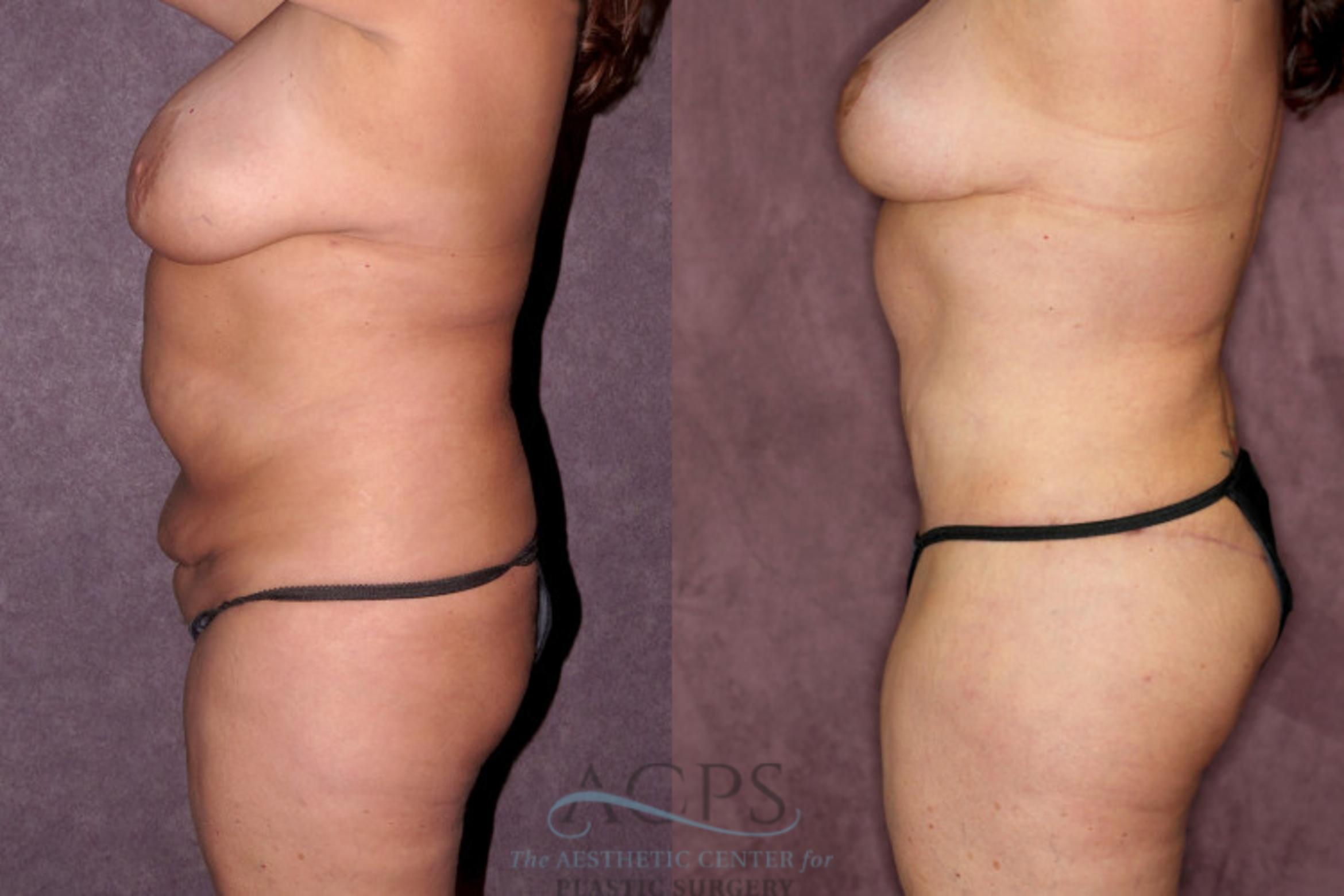Before & After Liposuction Case 257 Side Left View: View in Houston, TX