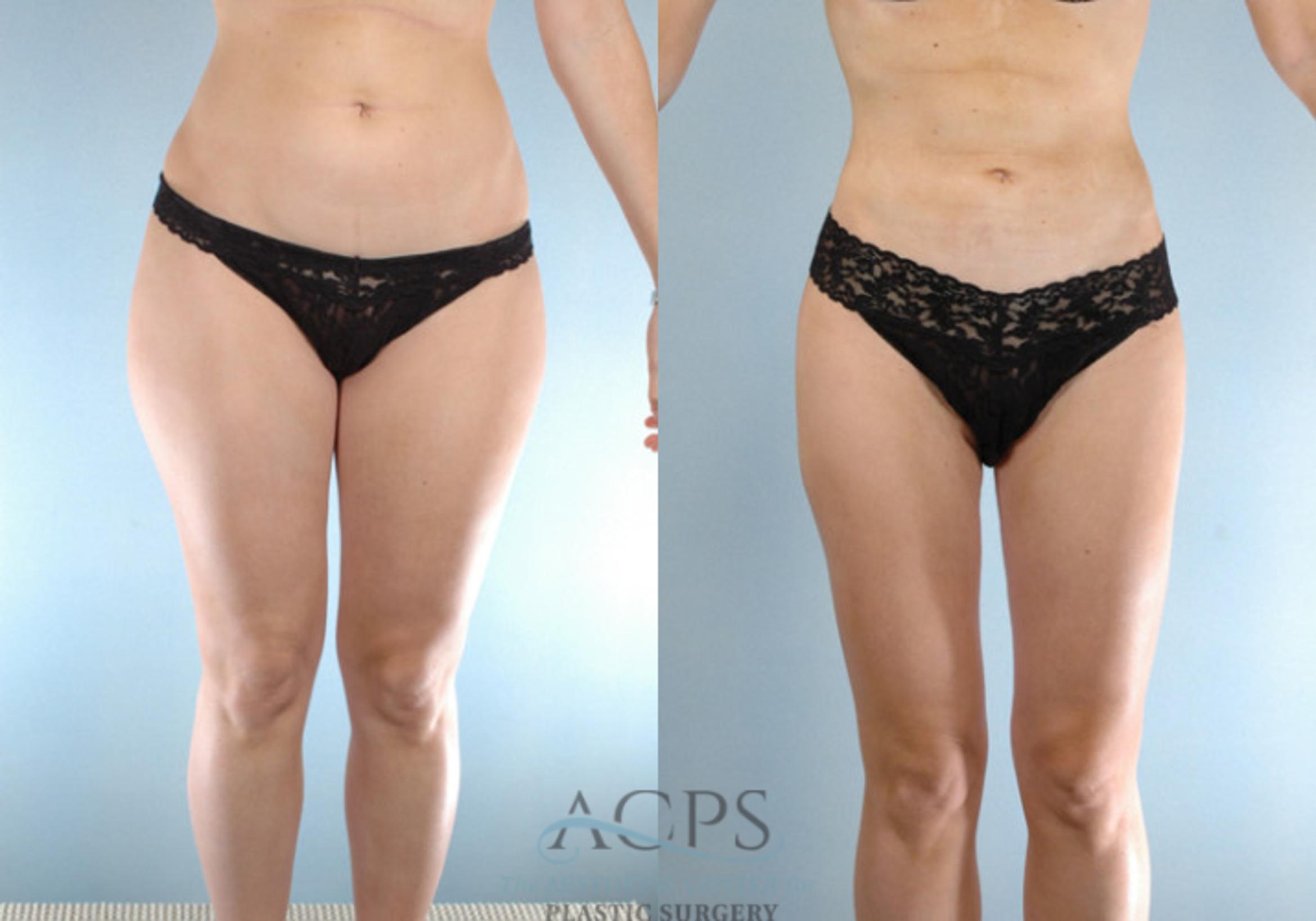 Before & After Liposuction Case 271 Front View: View in Houston, TX