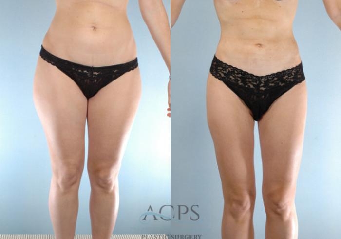 Before & After Liposuction Case 271 Front View: View in Houston, TX