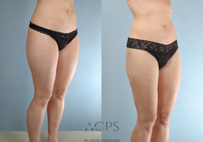 Before & After Liposuction Case 271 Oblique View: View in Houston, TX