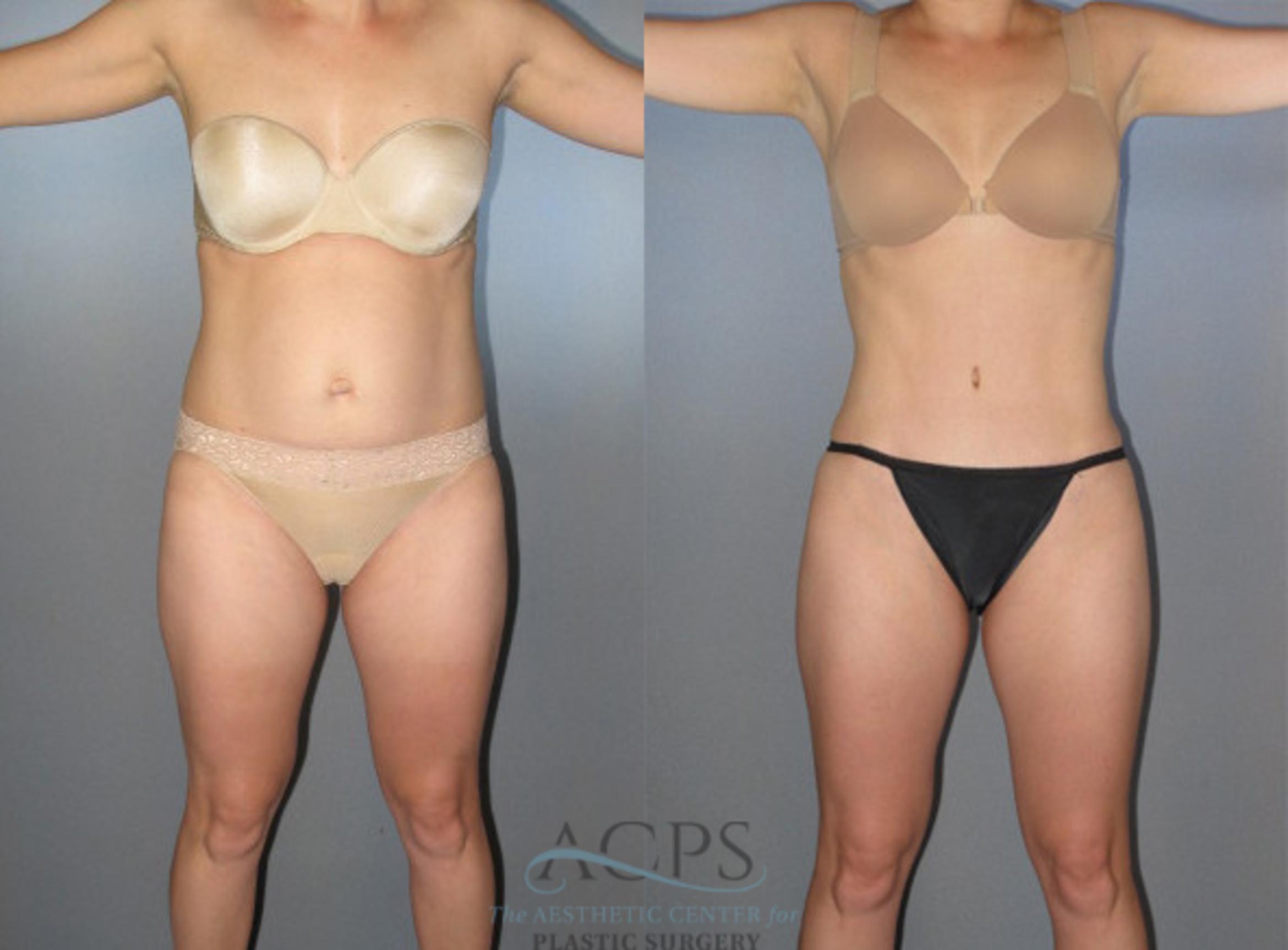 Before & After Liposuction Case 272 Front View: View in Houston, TX