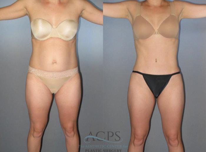 Before & After Liposuction Case 272 Front View: View in Houston, TX