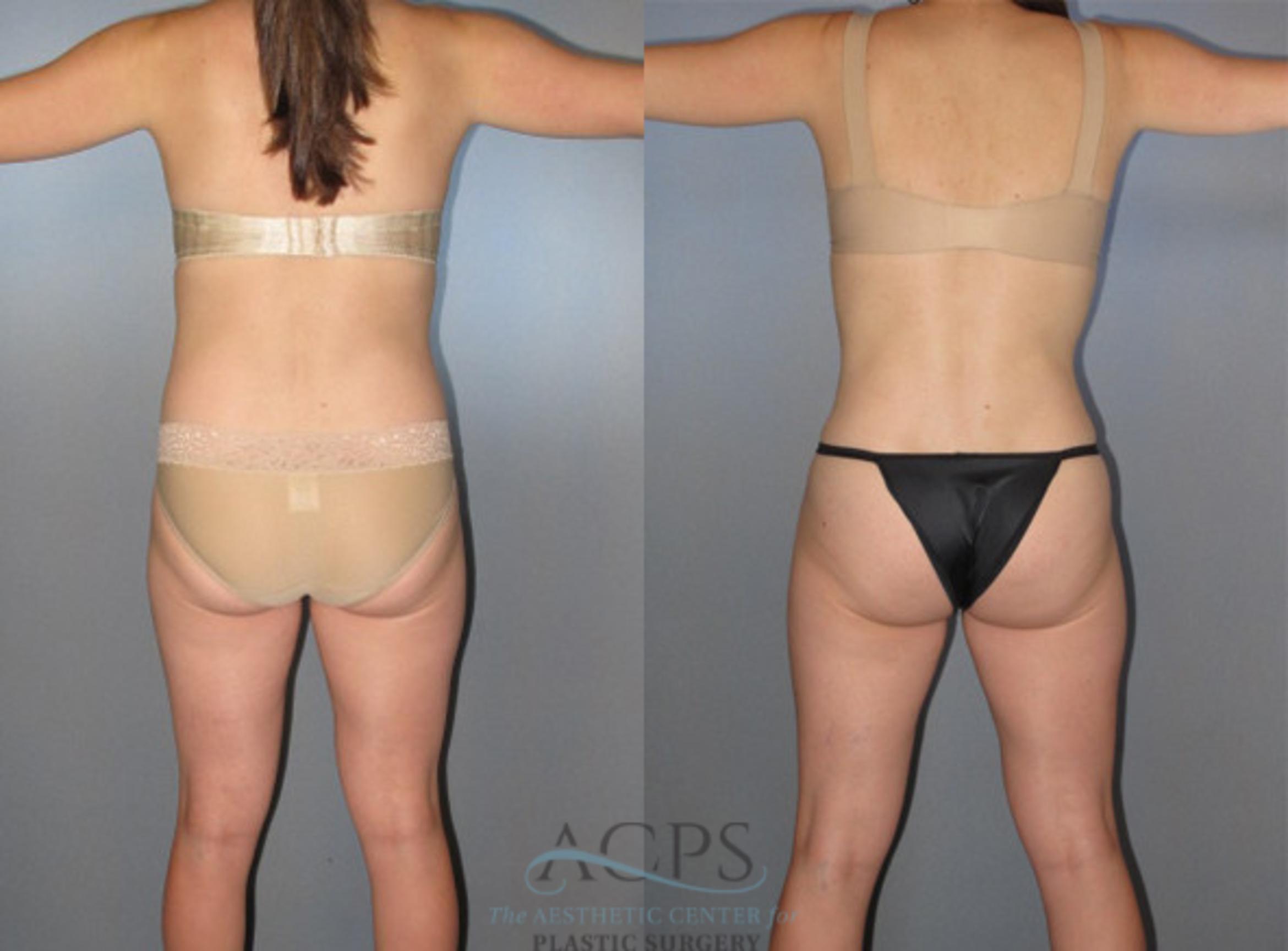Before & After Liposuction Case 272 Rear View: View in Houston, TX