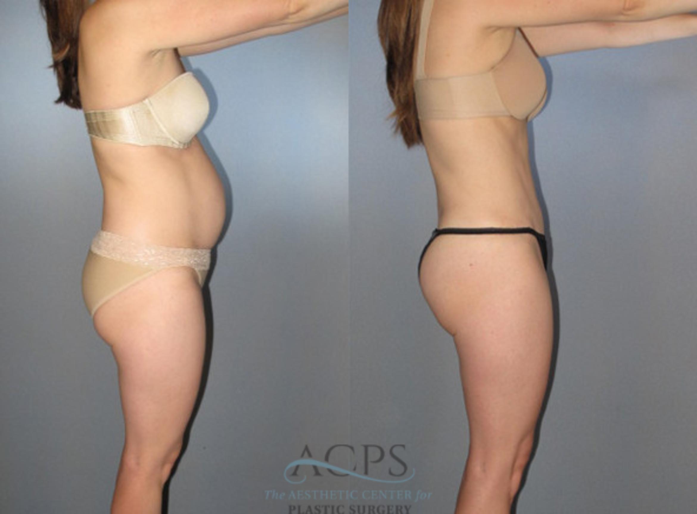 Before & After Liposuction Case 272 Side View: View in Houston, TX