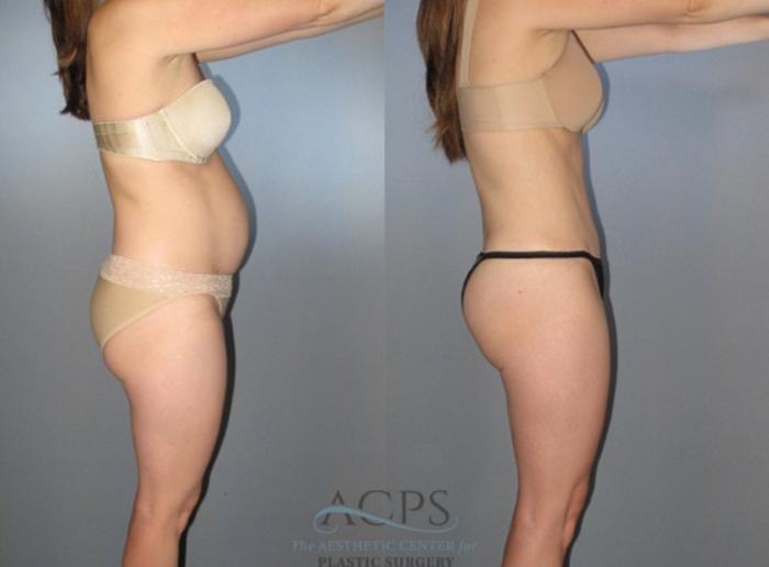 Before & After Liposuction Case 272 Side View: View in Houston, TX