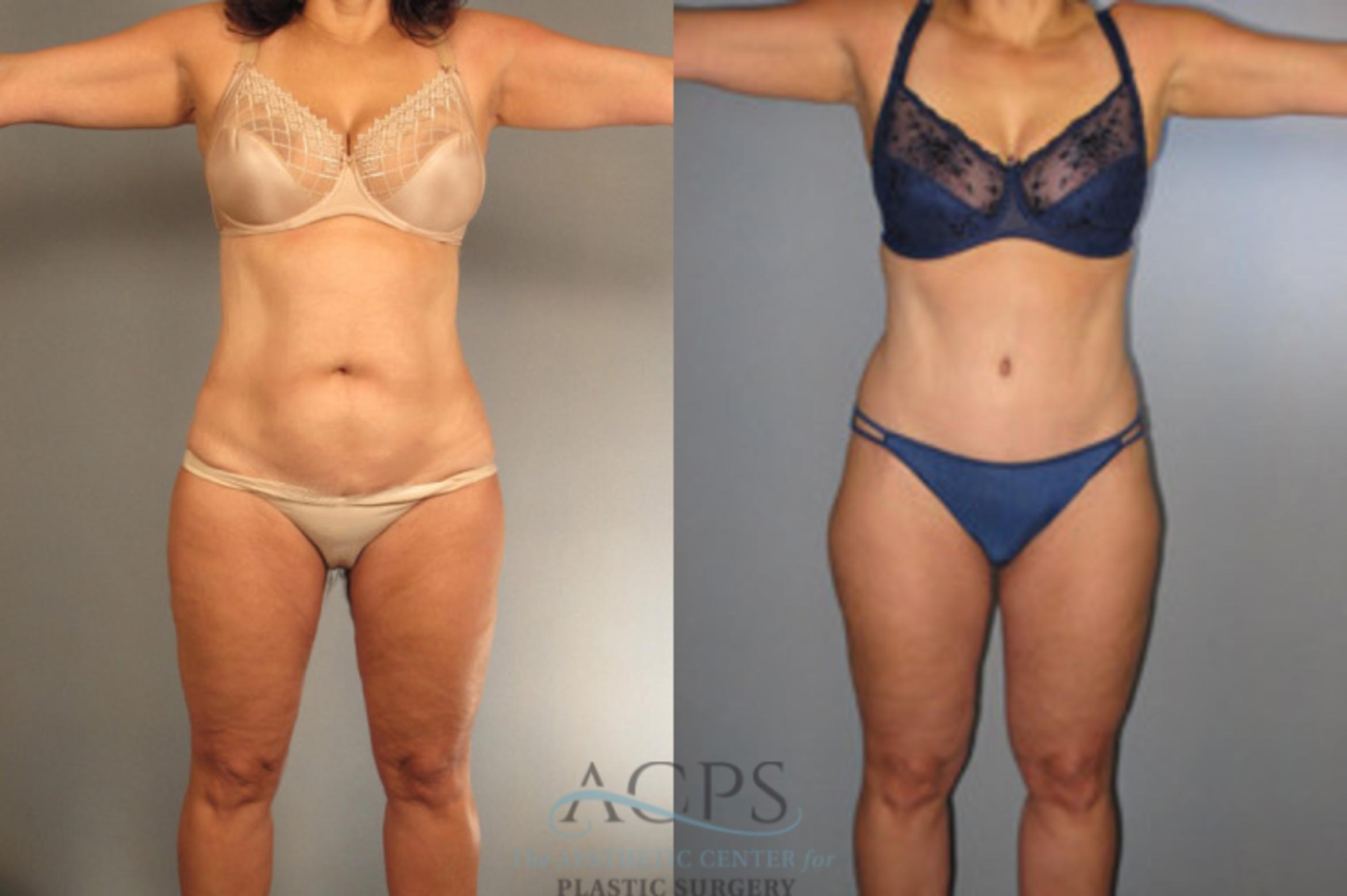 Before & After Liposuction Case 273 Front View: View in Houston, TX