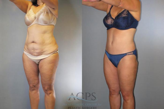 Before & After Liposuction Case 273 Oblique Left View: View in Houston, TX