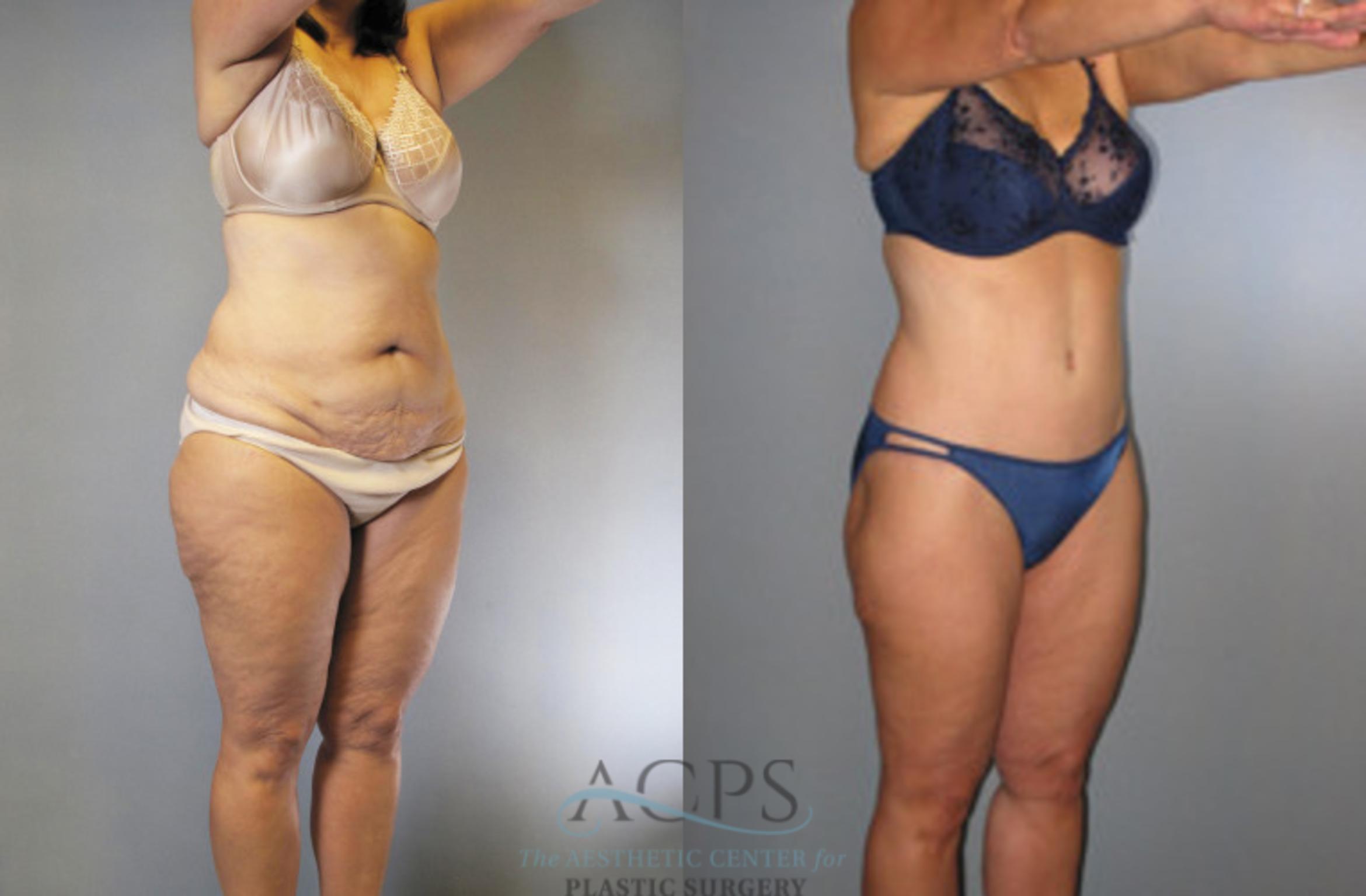 Before & After Liposuction Case 273 Oblique View: View in Houston, TX