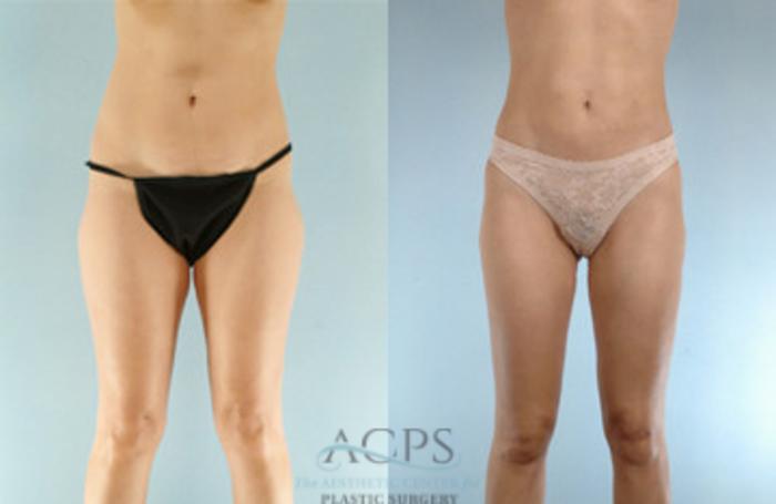 Before & After Liposuction Case 274 Front View: View in Houston, TX
