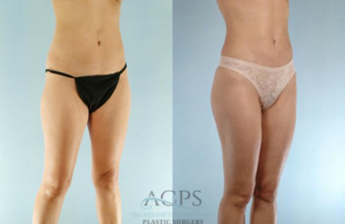 Before & After Liposuction Case 274 Oblique View: View in Houston, TX