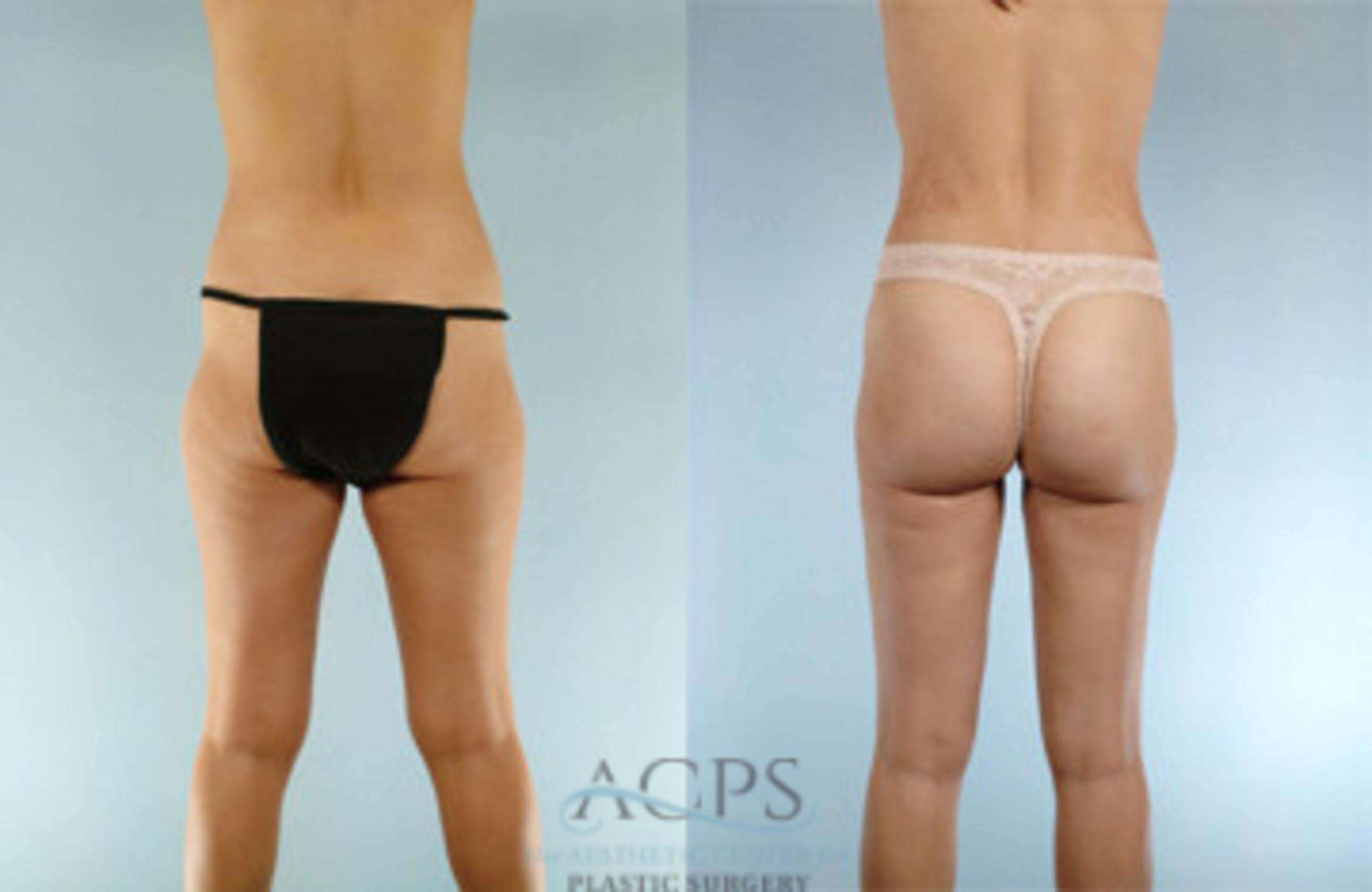 Before & After Liposuction Case 274 Rear View: View in Houston, TX