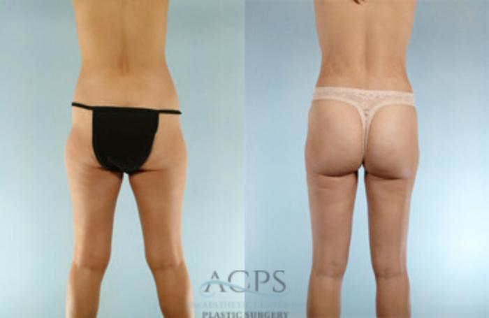 Before & After Liposuction Case 274 Rear View: View in Houston, TX