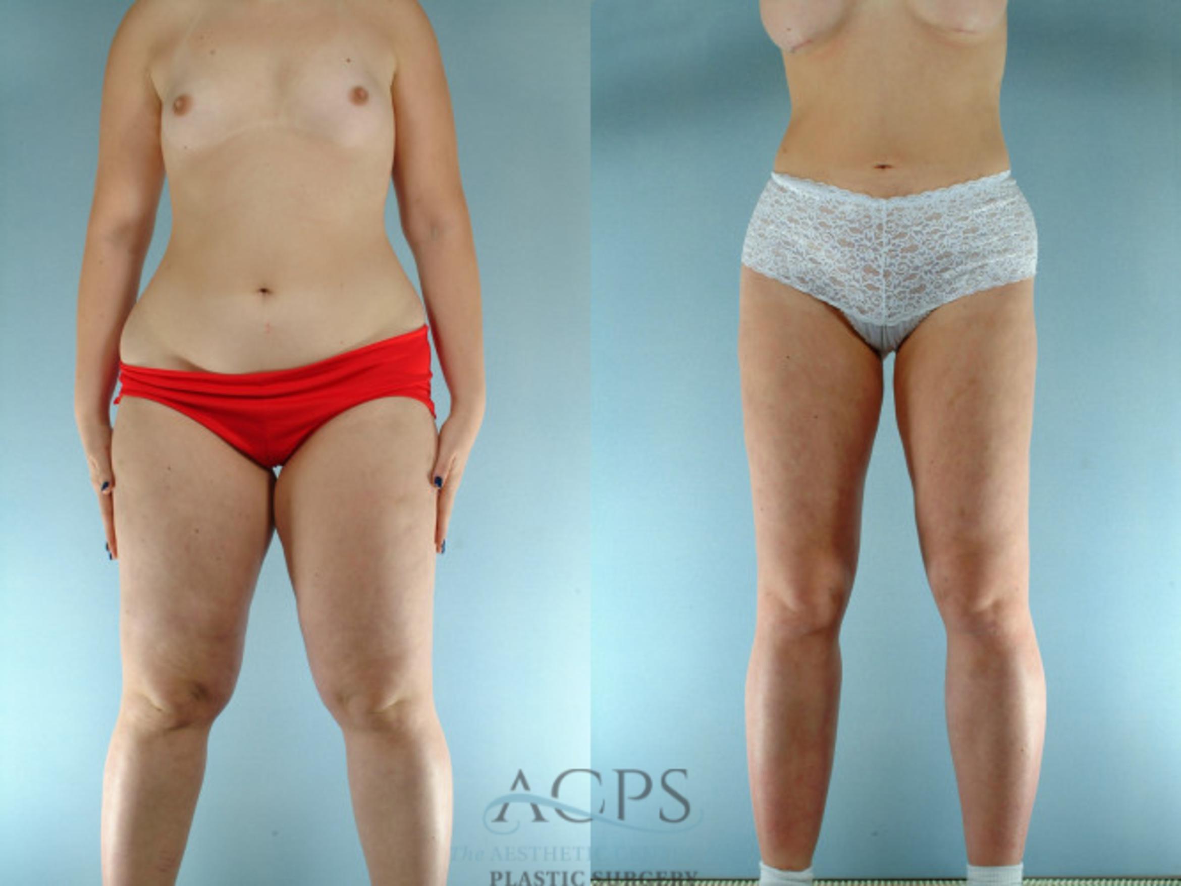 Before & After Liposuction Case 275 Front View: View in Houston, TX