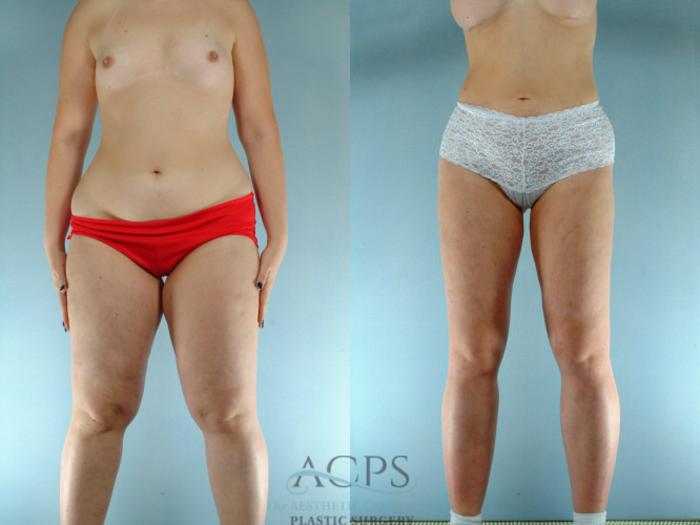 Before & After Liposuction Case 275 Front View: View in Houston, TX
