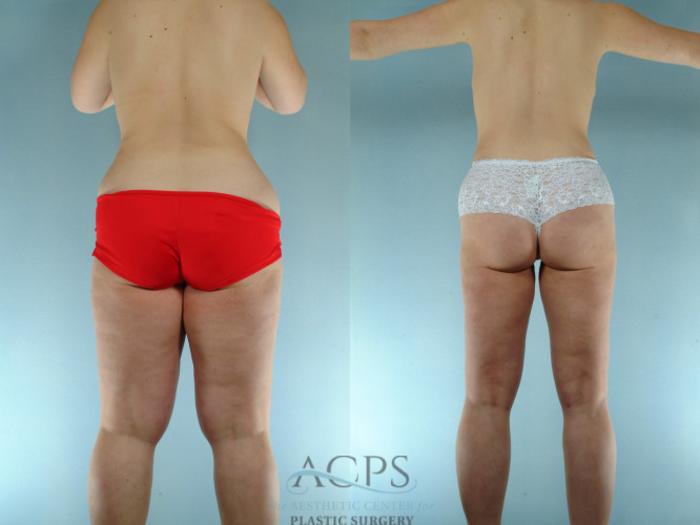 Before & After Liposuction Case 275 Rear View: View in Houston, TX