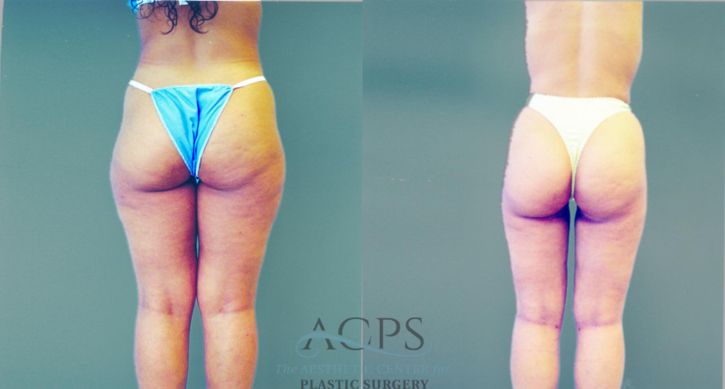 Before & After Liposuction Case 276 Rear View: View in Houston, TX