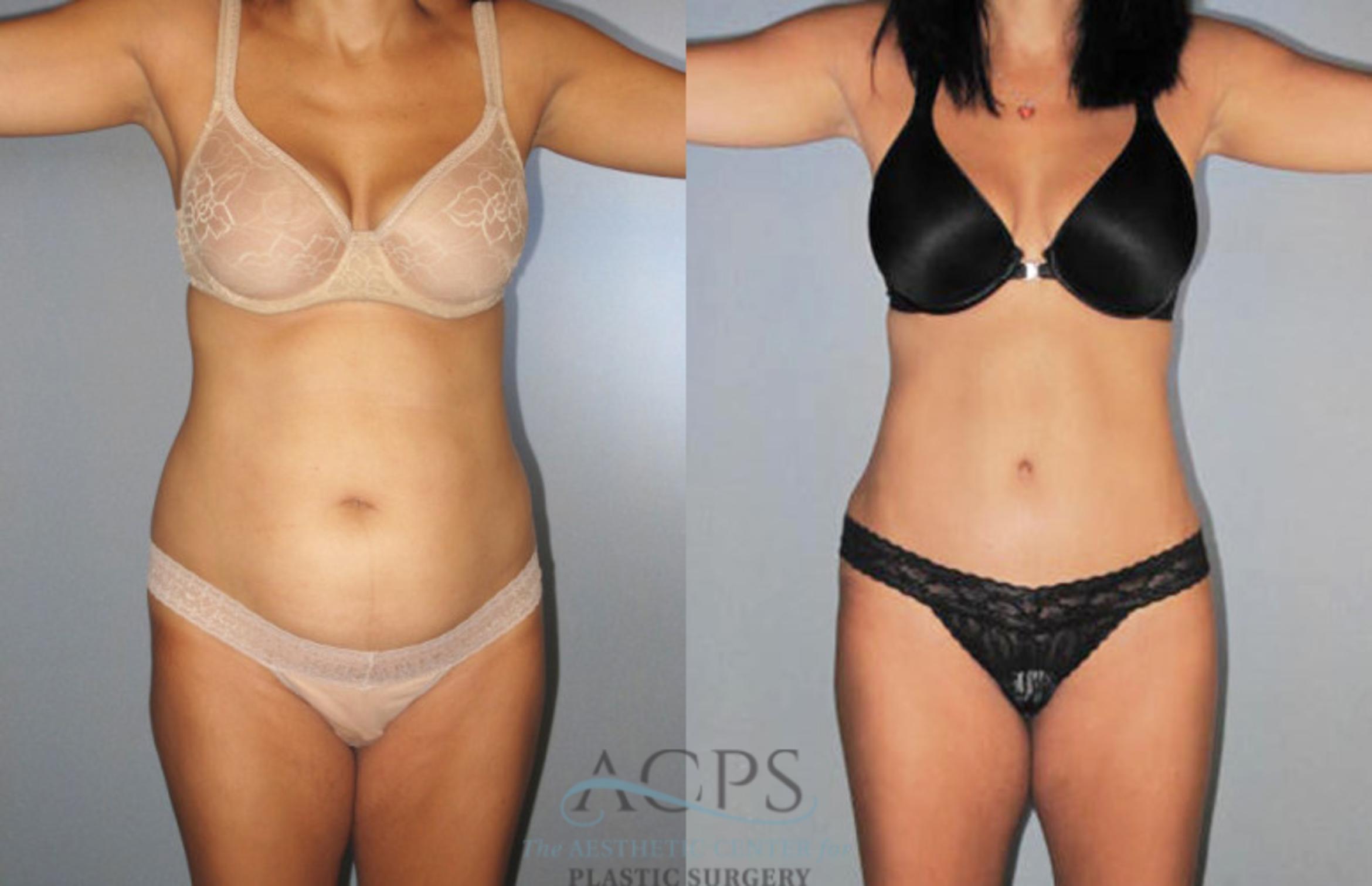 Before & After Liposuction Case 277 Front View: View in Houston, TX