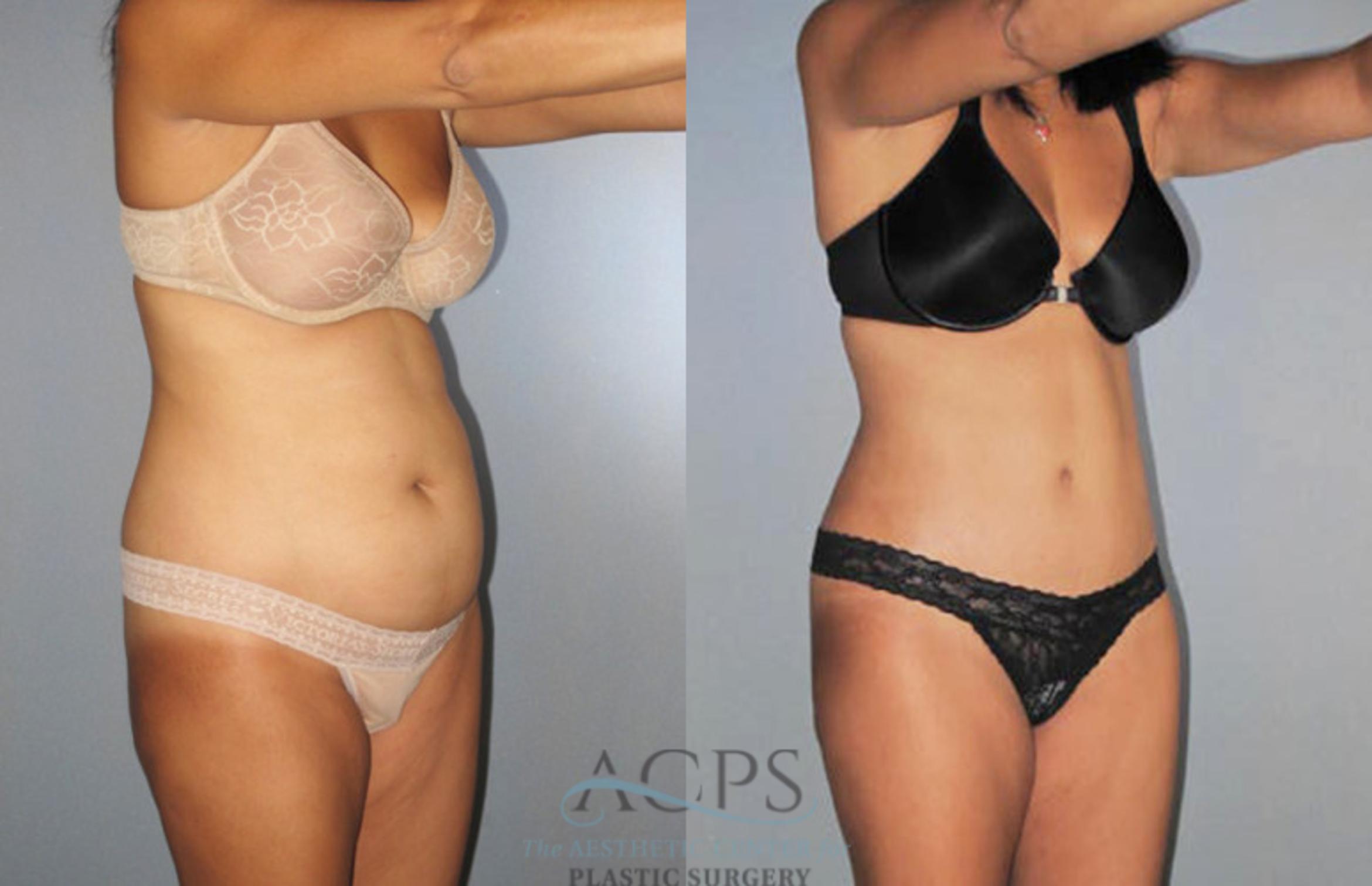 Before & After Liposuction Case 277 Oblique View: View in Houston, TX