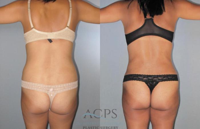 Before & After Liposuction Case 277 Rear View: View in Houston, TX