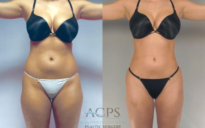 Before & After Liposuction Case 278 Front View: View in Houston, TX