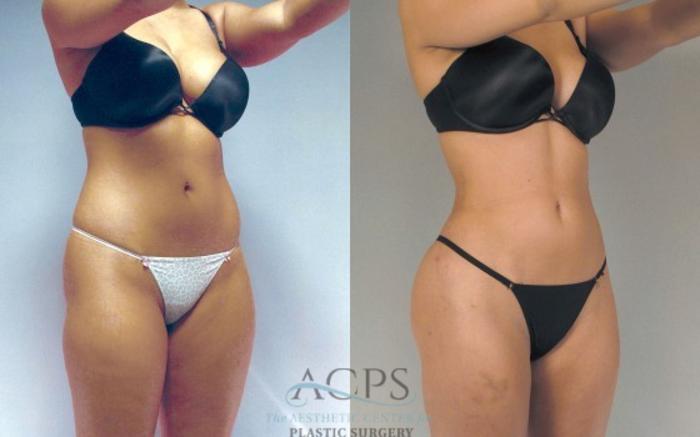 Before & After Liposuction Case 278 Oblique View: View in Houston, TX