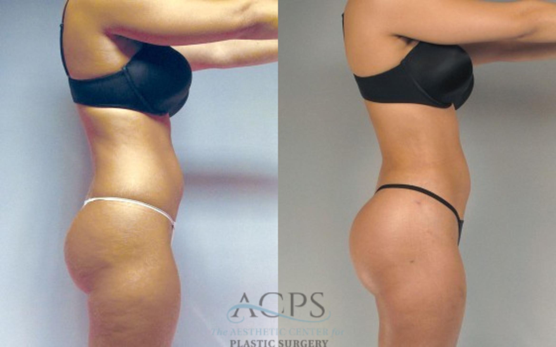 Before & After Liposuction Case 278 Side View: View in Houston, TX
