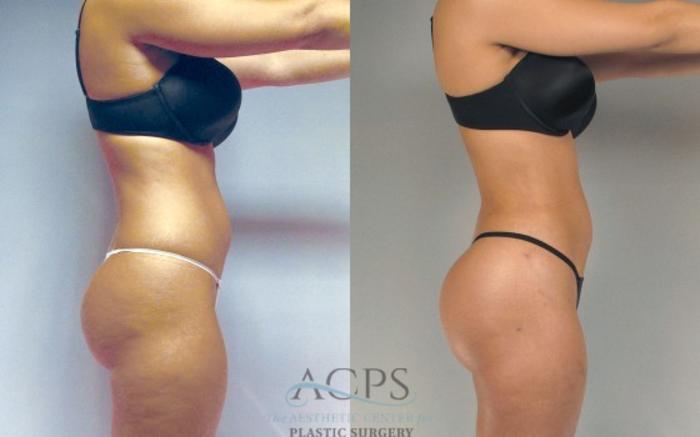 Before & After Liposuction Case 278 Side View: View in Houston, TX