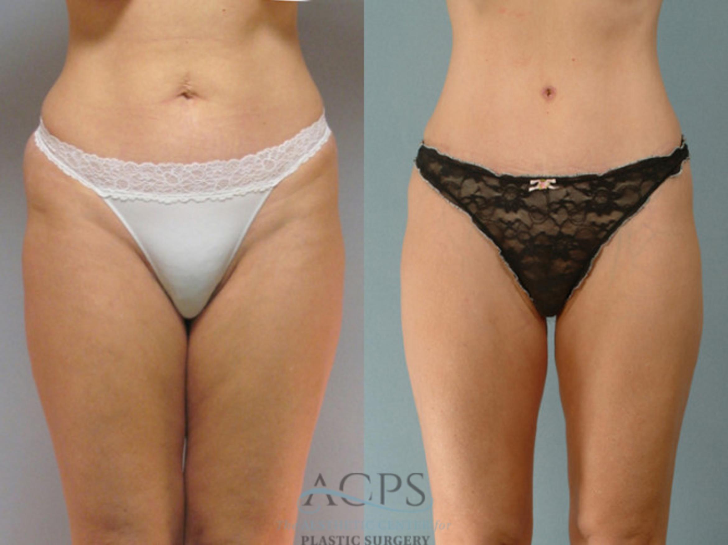 Before & After Liposuction Case 279 Front View: View in Houston, TX