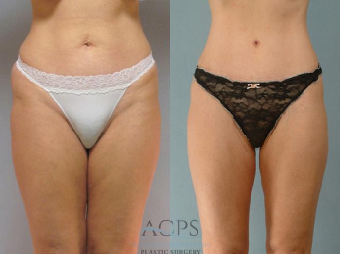 Before & After Liposuction Case 279 Front View: View in Houston, TX