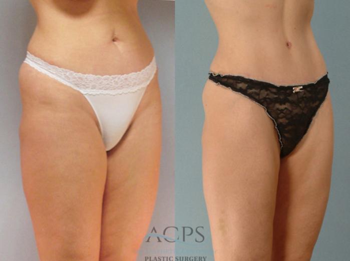 Before & After Liposuction Case 279 Oblique View: View in Houston, TX
