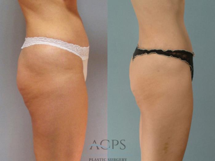 Before & After Liposuction Case 279 Side View: View in Houston, TX