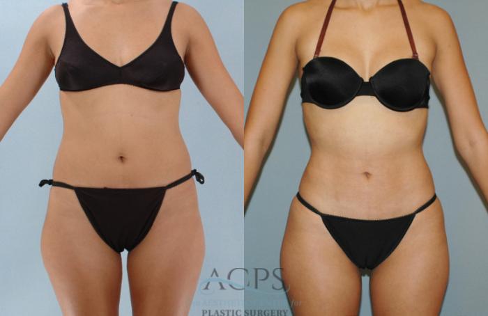Before & After Liposuction Case 280 Front View: View in Houston, TX