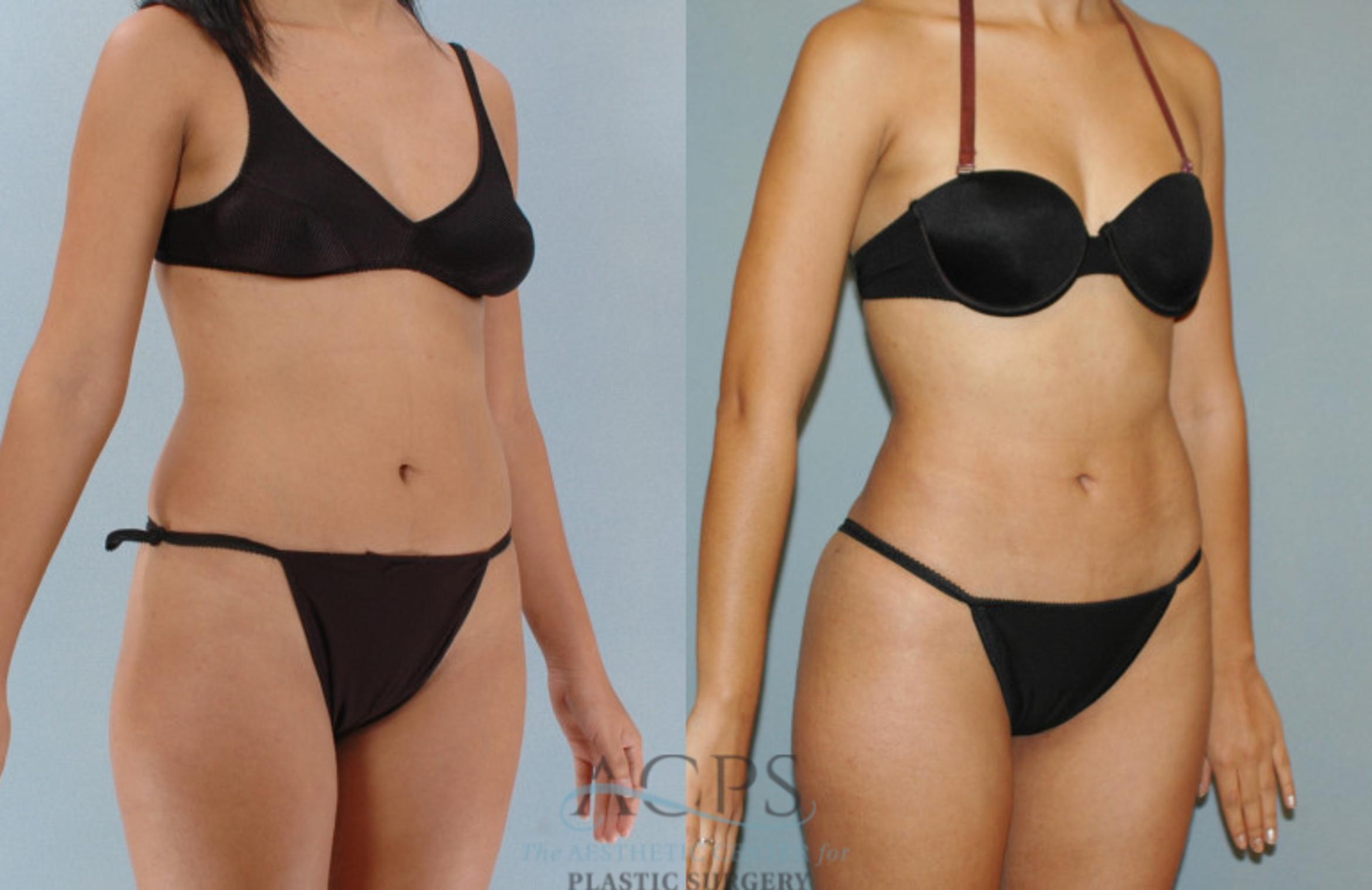 Before & After Liposuction Case 280 Oblique View: View in Houston, TX