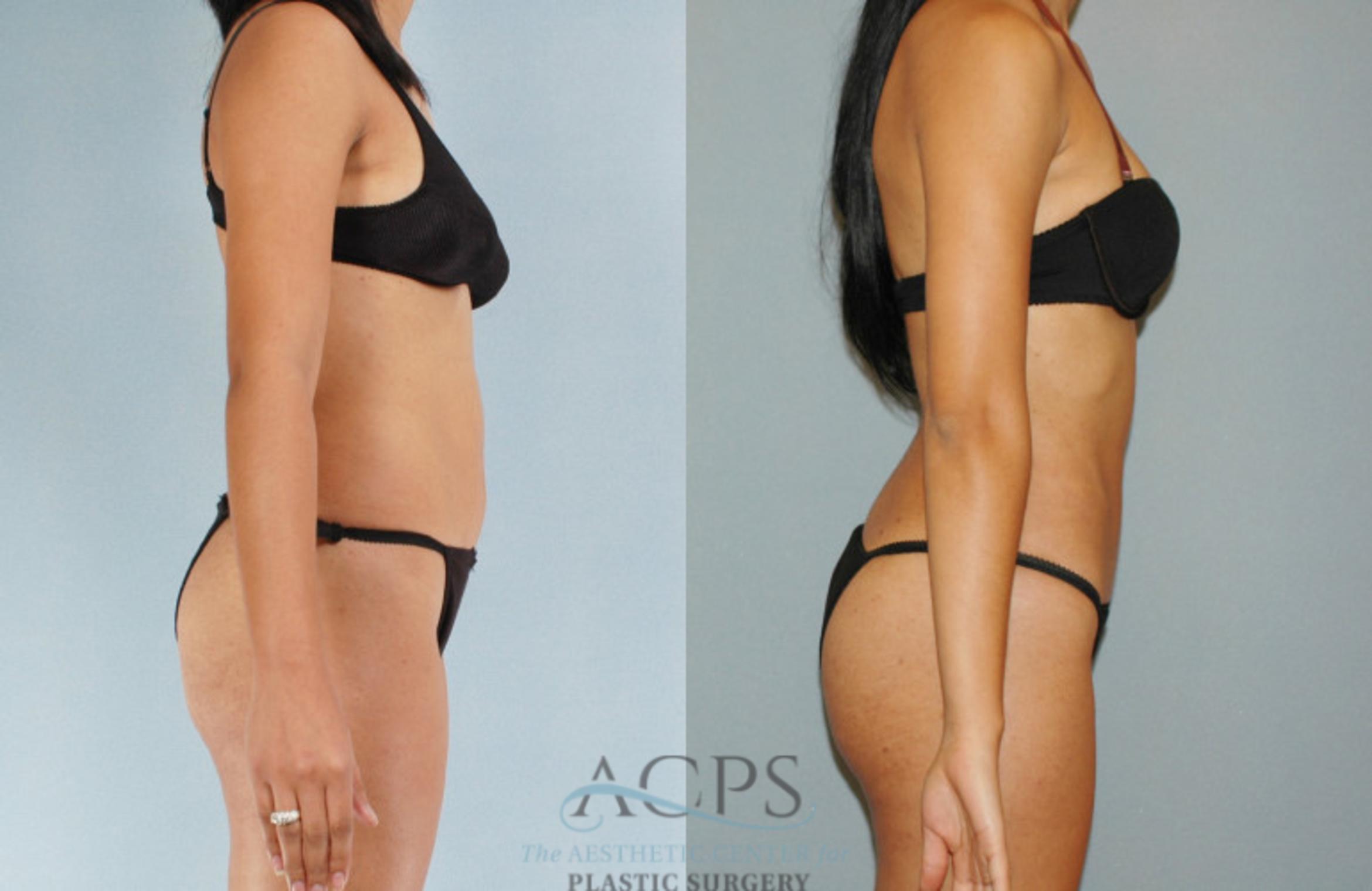 Before & After Liposuction Case 280 Side View: View in Houston, TX