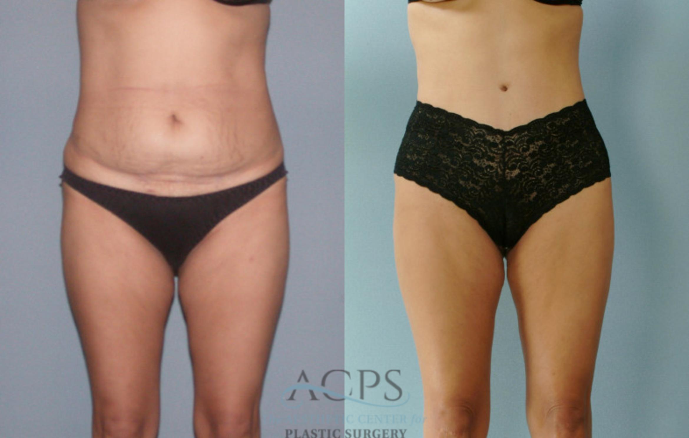 Before & After Liposuction Case 281 Front View: View in Houston, TX