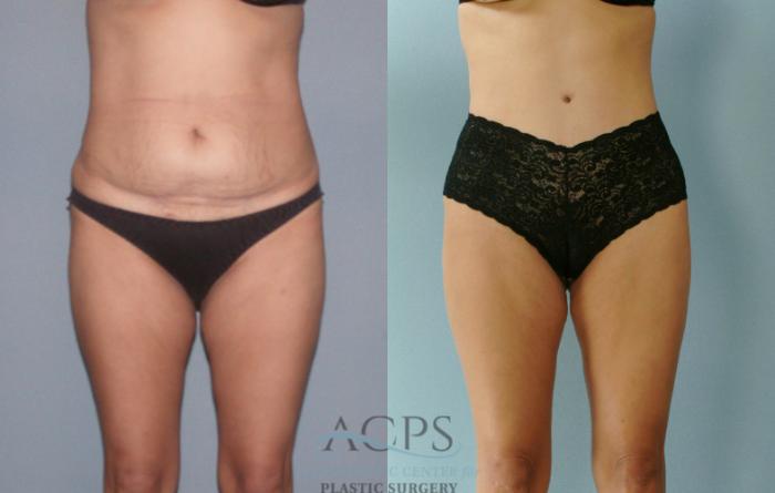 Before & After Liposuction Case 281 Front View: View in Houston, TX
