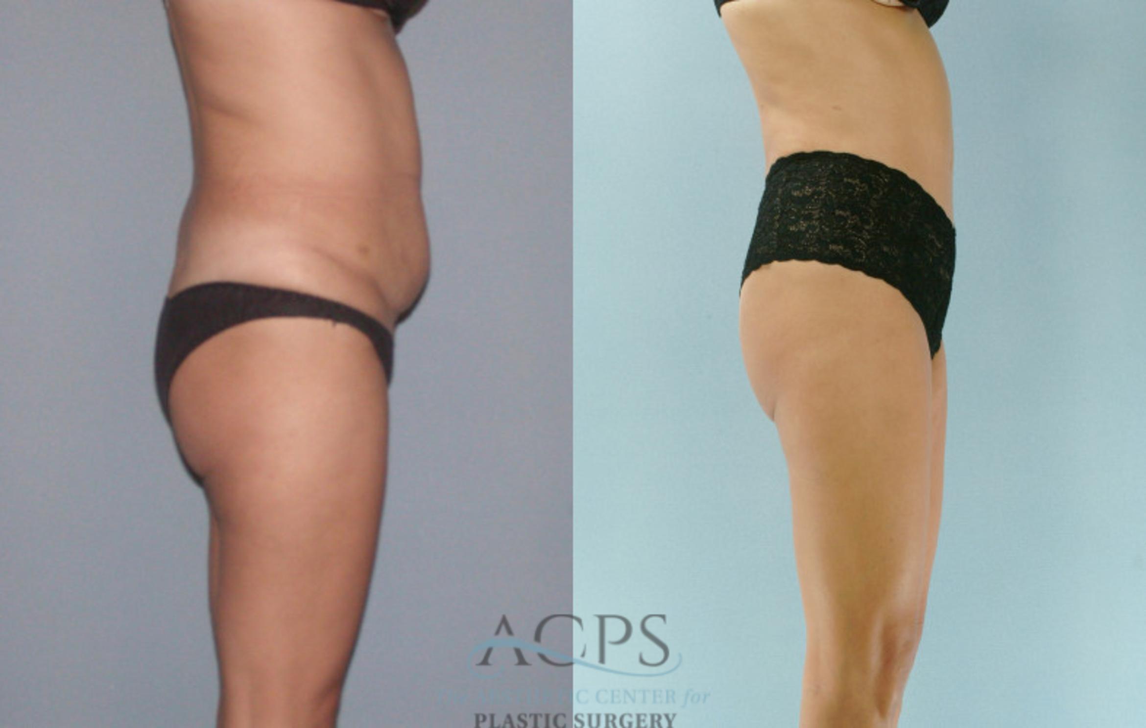 Before & After Liposuction Case 281 Side View: View in Houston, TX